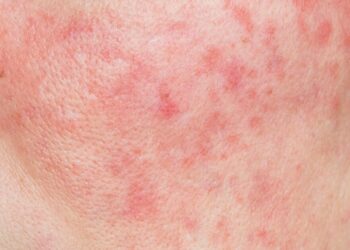 Aliments courants qui, sans le savoir, provoquent des rides et de l’acné