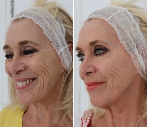 Carole avant et après le traitement
