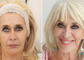 J’ai perdu 4 pierres sur ozempic – mais cela a causé un problème avec mon visage